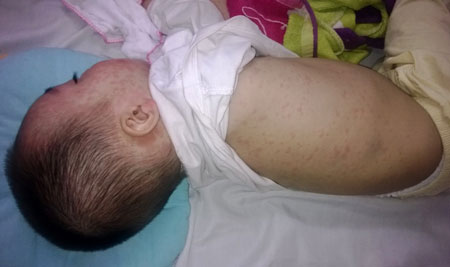 Không có hiện tượng  “sốt ” vắc xin sởi tại Hà Nội