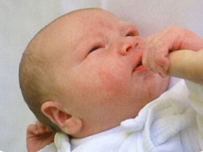 Chàm ở trẻ sơ sinh nguyên nhân và cách chữa bệnh ?