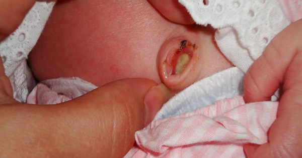 Nhiễm khuẩn rốn ở trẻ sơ sinh và cách xử lý như thế nào ?
